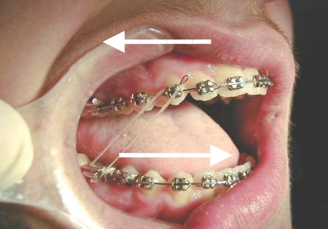 Ganci Crimpabili Ortodontici Gancio Di Trazione A Sfera Tubo - Foto 11